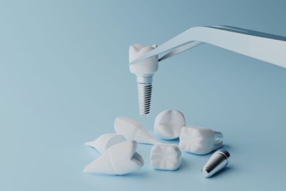 zobni implantati